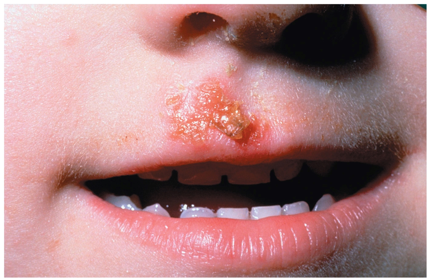 <p><span style="background-color: transparent;"><span>Agent: </span><em><span>Staphylococcus aureus</span></em></span></p><p><span style="background-color: transparent;"><u><span>Impetigo</span></u><span>: small, flattened red patches usually on the face and limbs, usually on children </span></span></p><p><span><span>-Pus filled vesicles that break, forming a thick honey-colored crust</span></span></p><p><span style="background-color: transparent;"><span> </span><u><span>Scalded skin syndrome</span></u><span>: separation of the outer layer of skin by the toxins released by </span><em><span>Staphylococcus</span></em></span></p><p><br></p>