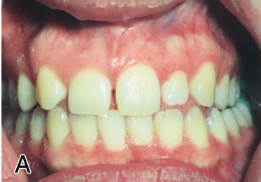 <ul><li><p>lack of initiation within the dental lamina results in the absence of a single tooth, multiple teeth, or even an entire dentition</p></li><li><p>also known as hypo (less) dontia</p></li><li><p>hereditary </p></li></ul><p></p>