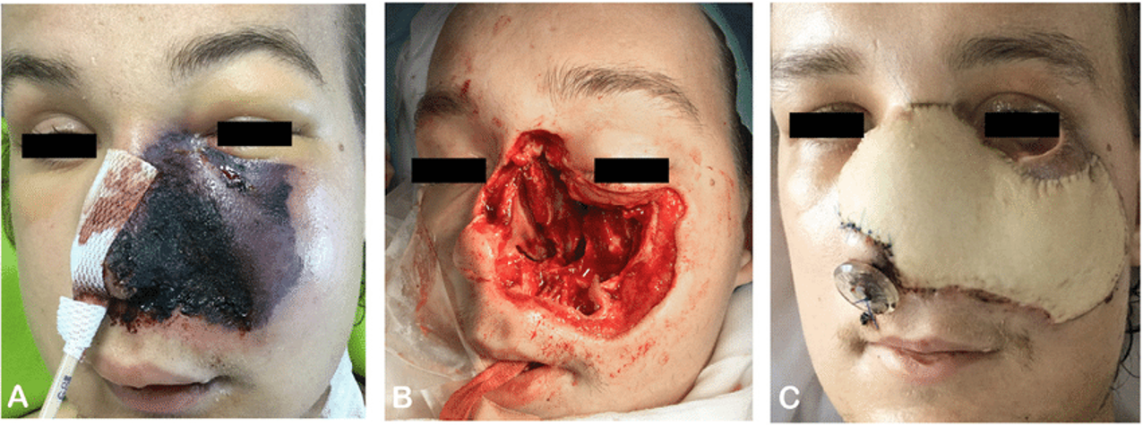 <p>sx similar to bacterial sinusitis; facial pain is more severe; palate/nasal mucosa is black necrotic tissue; cranial neuropathies</p>