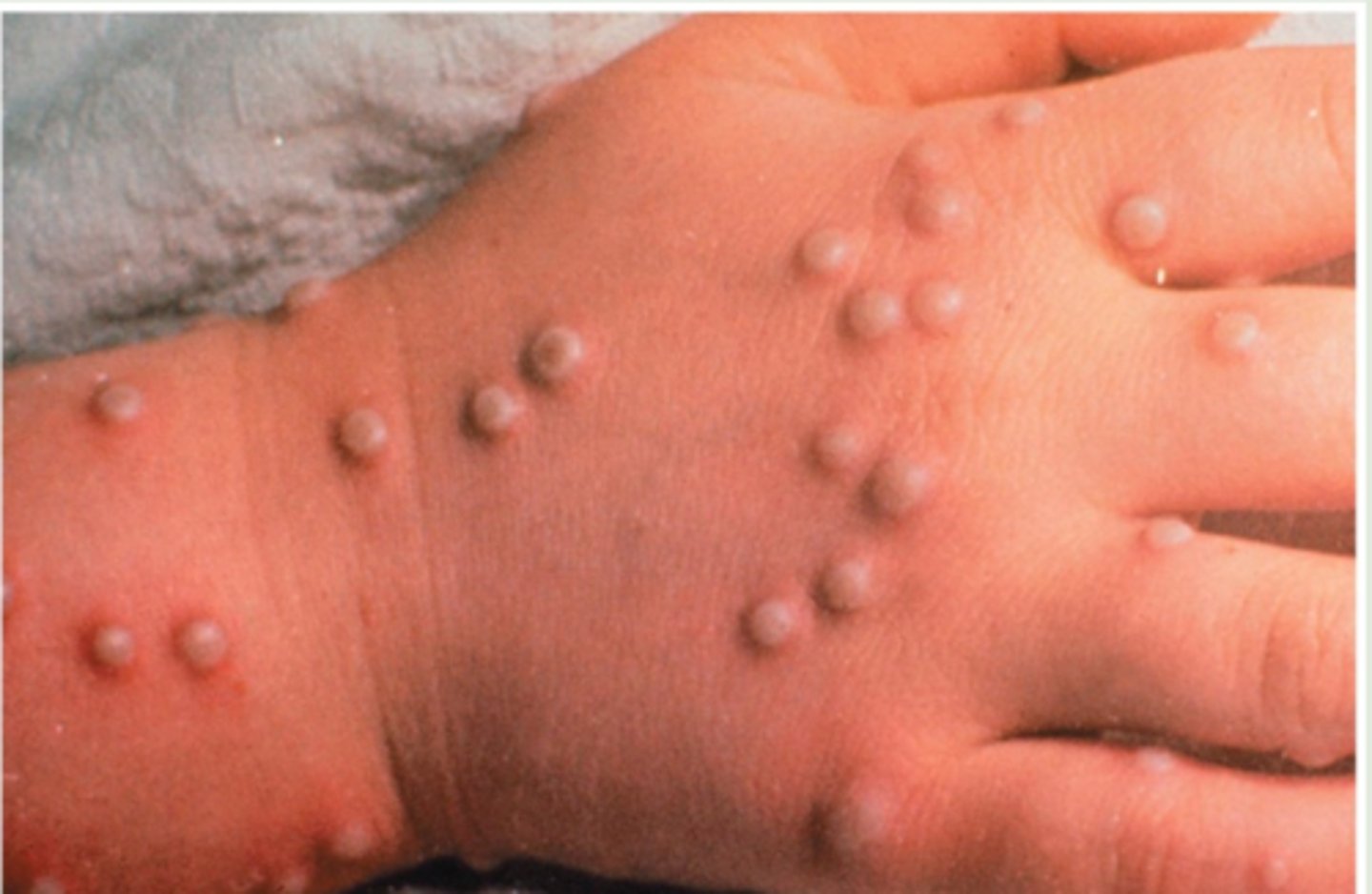 <p>smallpox</p>