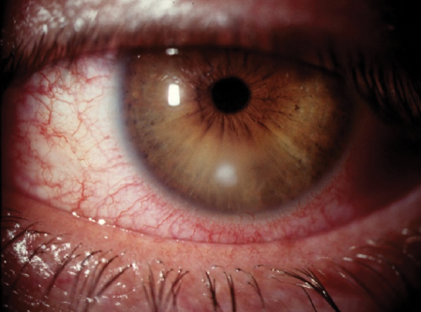 corneal ulcer - note white spot