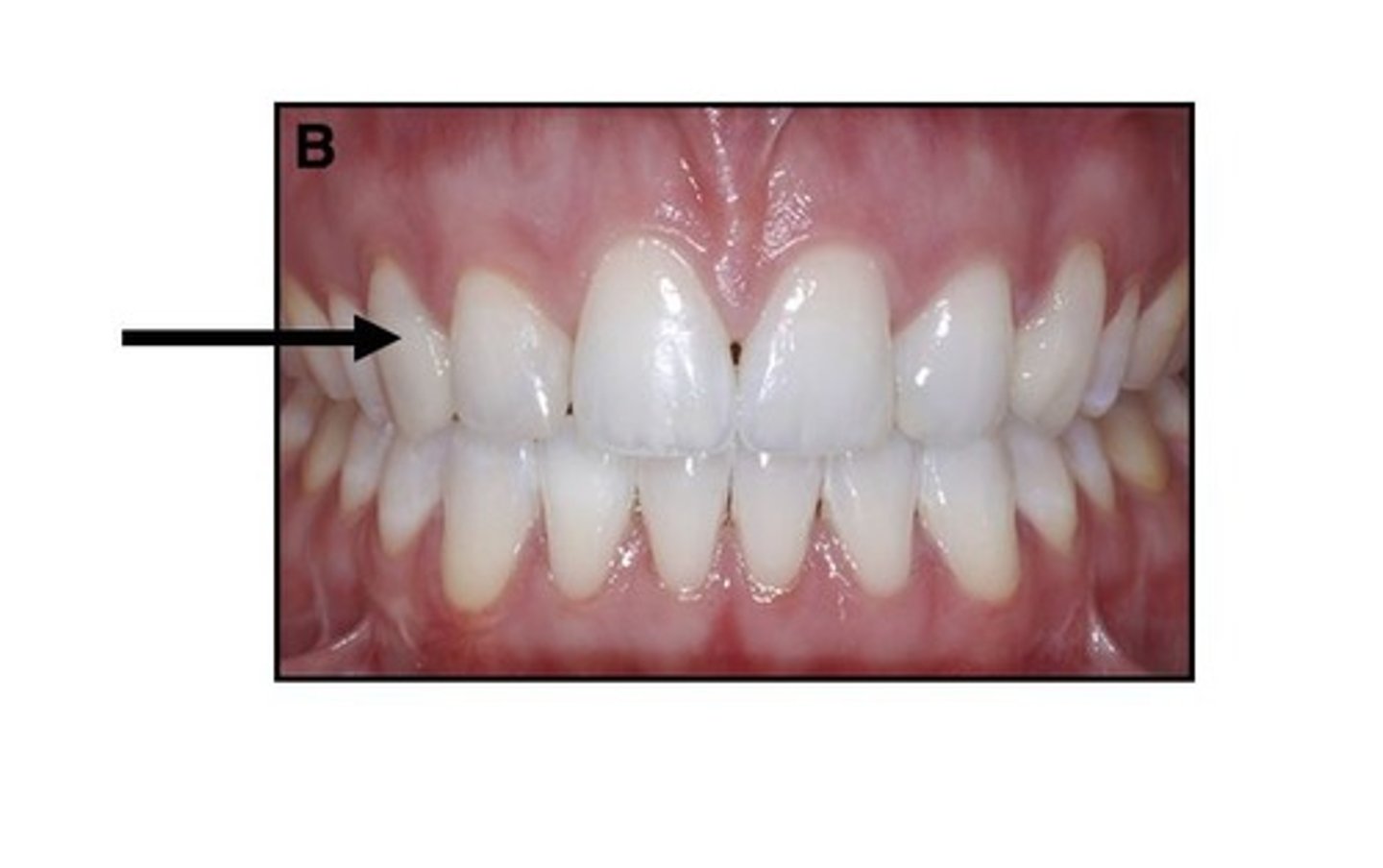 <p>Using the Universal Numbering System, what tooth number is this?</p>