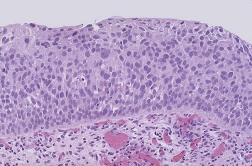  A 58-year-old man from Shanghai has noted passing darker urine within the past 3 weeks. On physical examination, there are no abnormalities. Urinalysis shows blood is present. Cystoscopy is performed and there is a 0.5 × 1.7 cm reddish area on the dome of the bladder. Biopsies are obtained and have the microscopic appearance shown in the figure. What is the most likely risk factor for his disease?   \n  