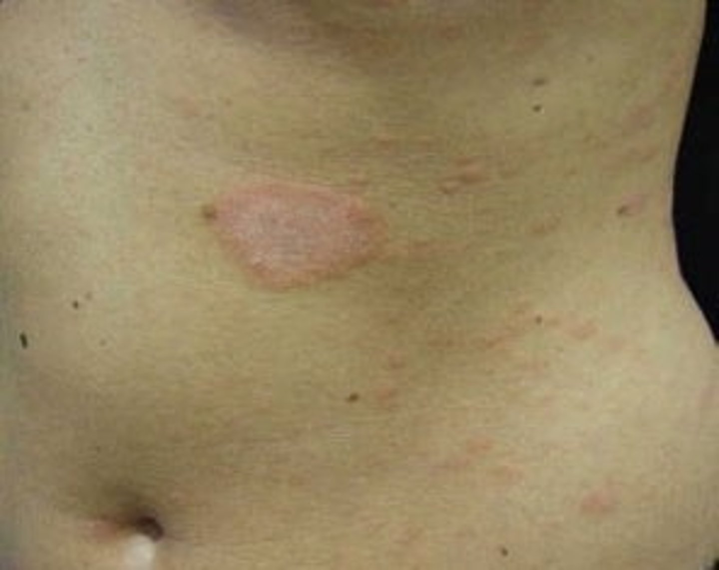 <p>Pityriasis Rosea</p>