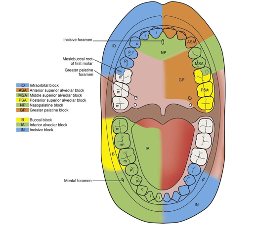 <p></p><ul><li><p>mandibular block</p></li><li><p><strong><u>most commonly used block in dentistry</u></strong></p></li><li><p>anesthetizes: mandibular teeth to midline, associated lingual periodontium, gingiva, and facial periodontium to the midline</p></li><li><p>target: IA nerve exiting the mandibular foramen on medial surface of the mandibular ramus</p></li><li><p>insertion: 2/4 distance from <strong><u>coronoid</u></strong> notch to deepest part of the pterygomandibular raphe, 6-10 mm above mandibular occlusal plane</p></li><li><p>can cause hematoma if injected into pterygoid plexus</p></li></ul><p></p><p></p>