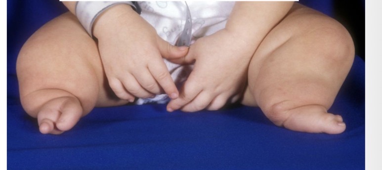 <p>kokia įgimta deformacija</p>