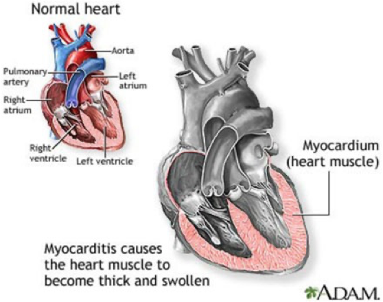 <p>Myocarditis</p>