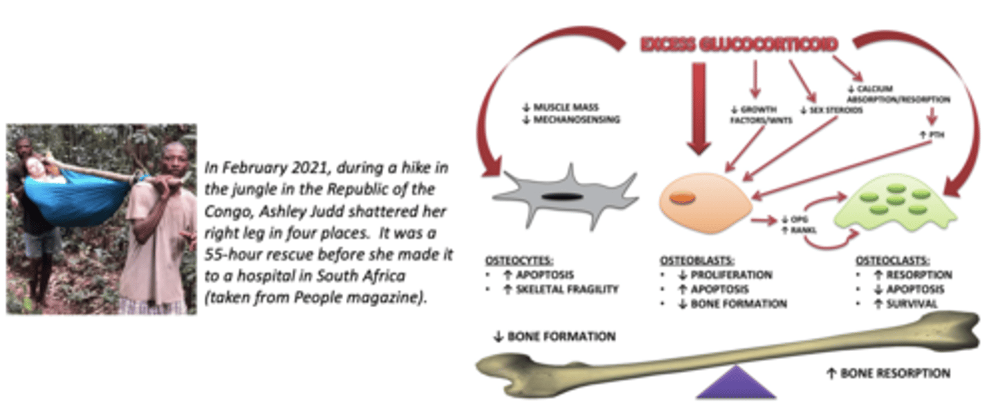 <p>glucocorticoid-induced osteoporosis, note that Ashley Judd had a combo of chronic glucocorticoid use AND post-menopausal low estrogen = higher risk of osteoporosis, and need for regular bone mineral density monitoring:</p>