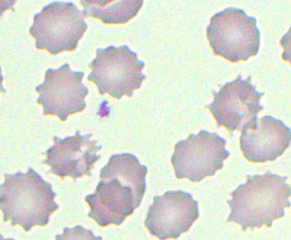 <p>Other term for echinocytes; <span>due to an accumulation of lipids in the outer half of the red blood cell's membrane</span></p>