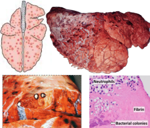 <p>What pattern of lung pathology? Describe appearance and pathogenesis. 2 example causes.</p>