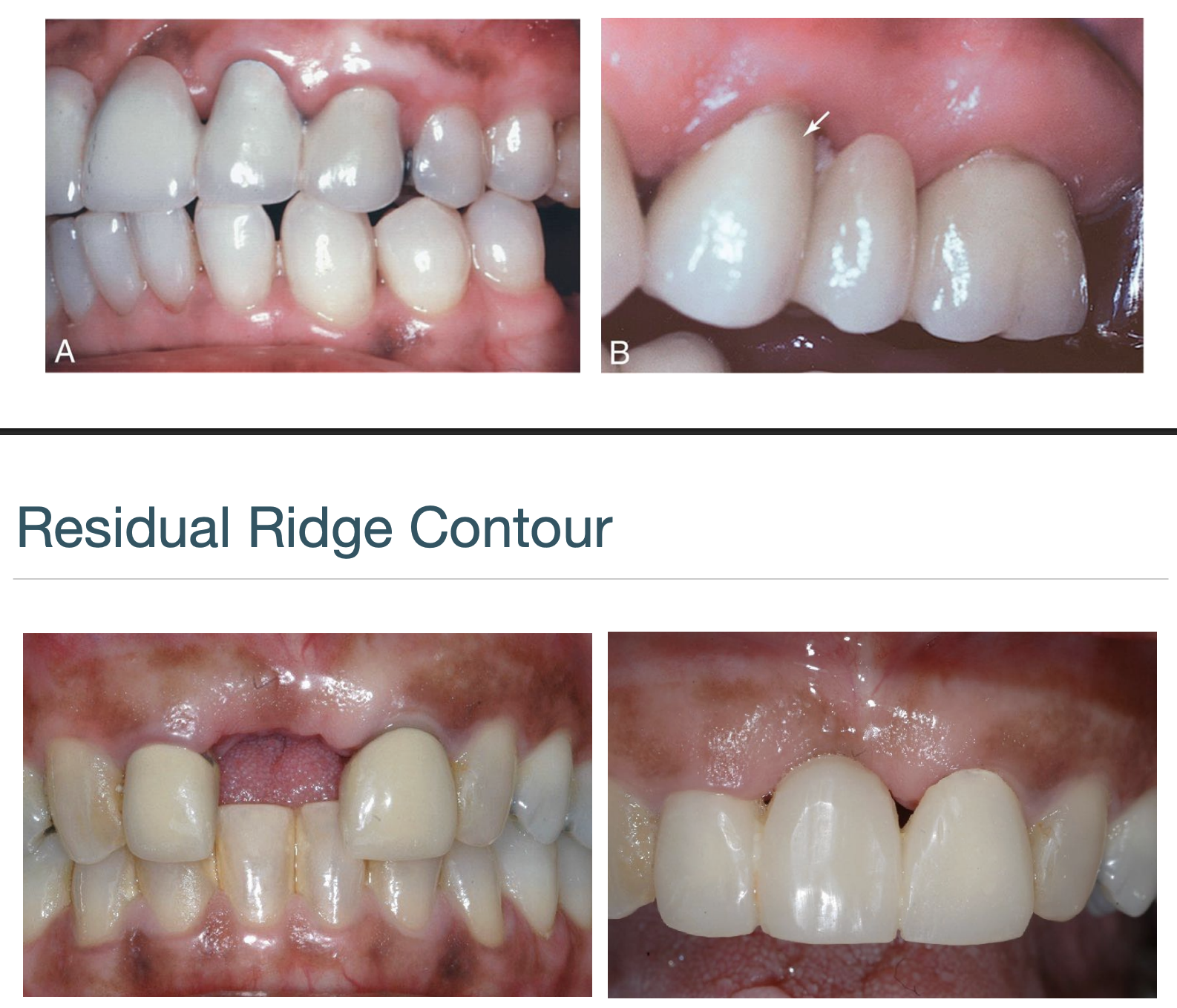 <p>unesthetic gingival embrasures (black triangles), food impaction, and percolation of saliva during speech </p>