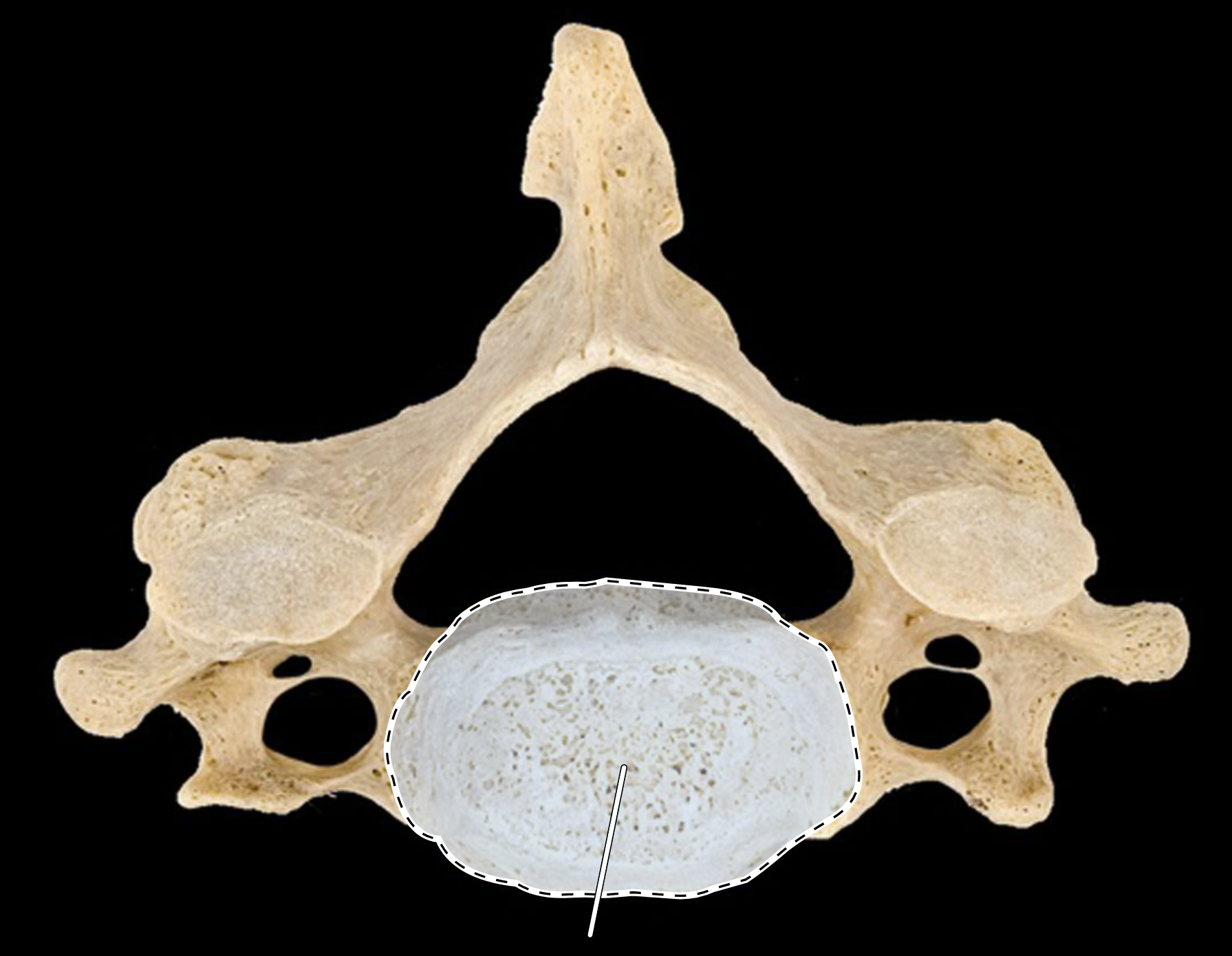 <p>Name the highlighted portion.</p><p>(Cervical vertebra, superior view).</p>