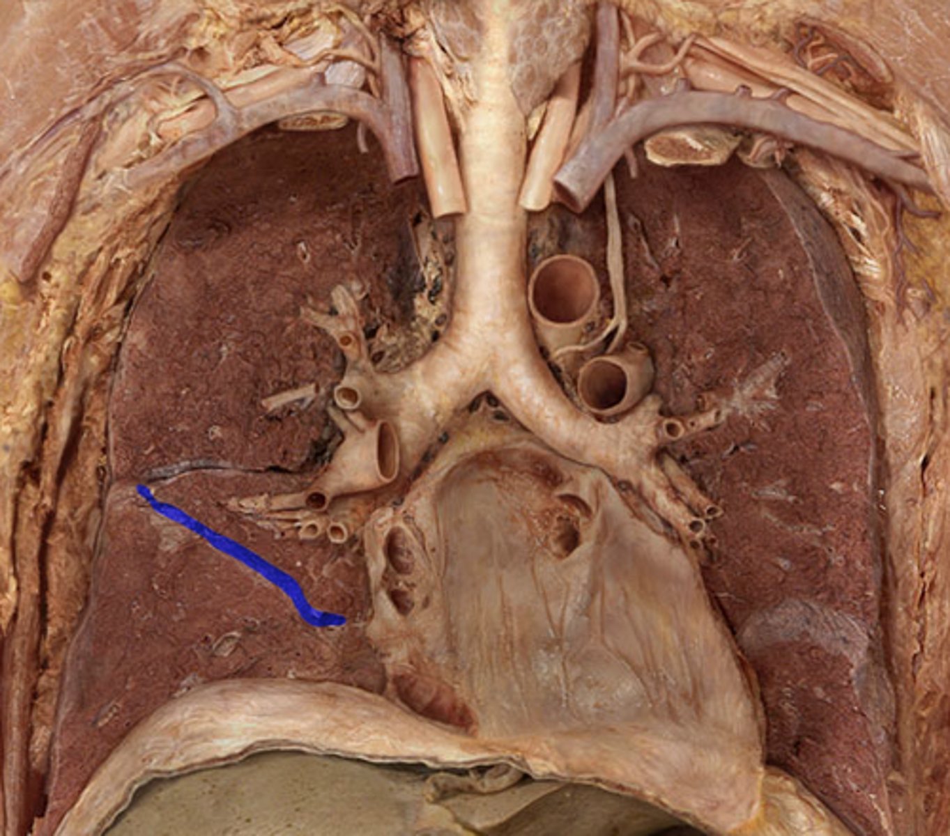 <p>between superior/middle lobes and inferior lobe</p>
