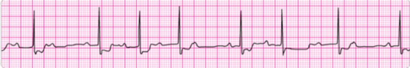 <p>Identify the rhythm.</p>