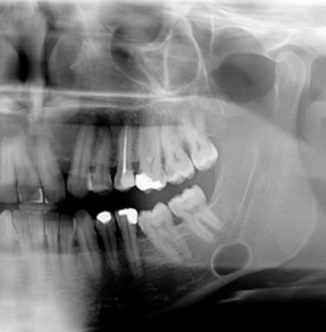 <p>developmental defect BELOW<strong> mandibular canal near angle of mandible</strong></p>