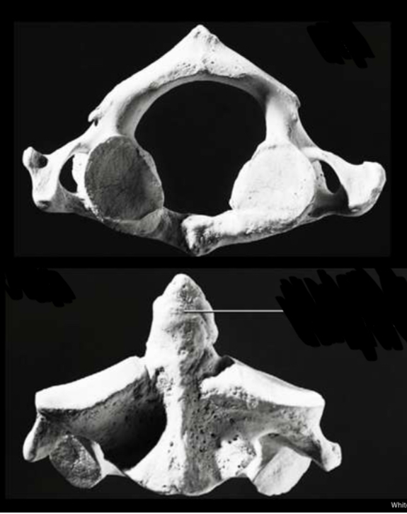 <p>Identify the axis cervical vertebrae</p>