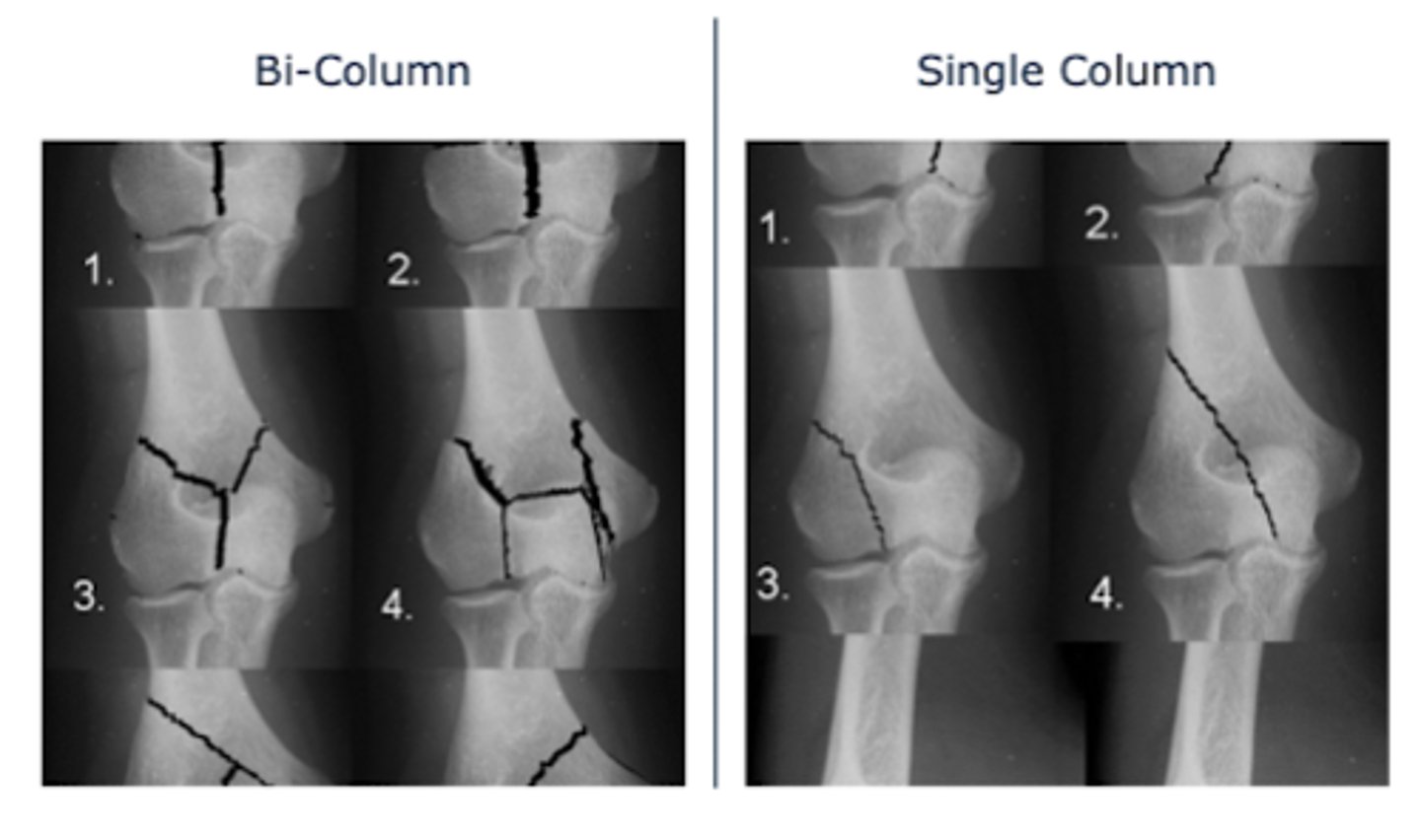 <p>ulnar nerve injury</p>