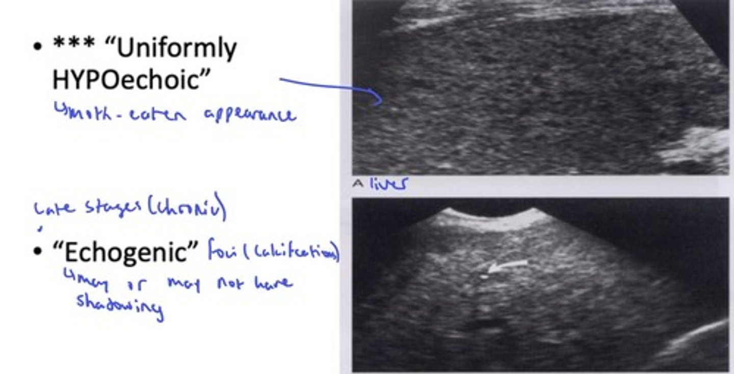 <p>- Early stages: wheel within a wheel, bull's eye (1-4cm); Hyperechoic centre, hypoechoic rim</p><p>- Uniformly hypoechoic (moth-eaten appearance)</p><p>- Late/chronic: echogenic foci (calcifications w/ or w/o shadowing)</p><p>- Microabscesses: multiple small hypoechoic</p>
