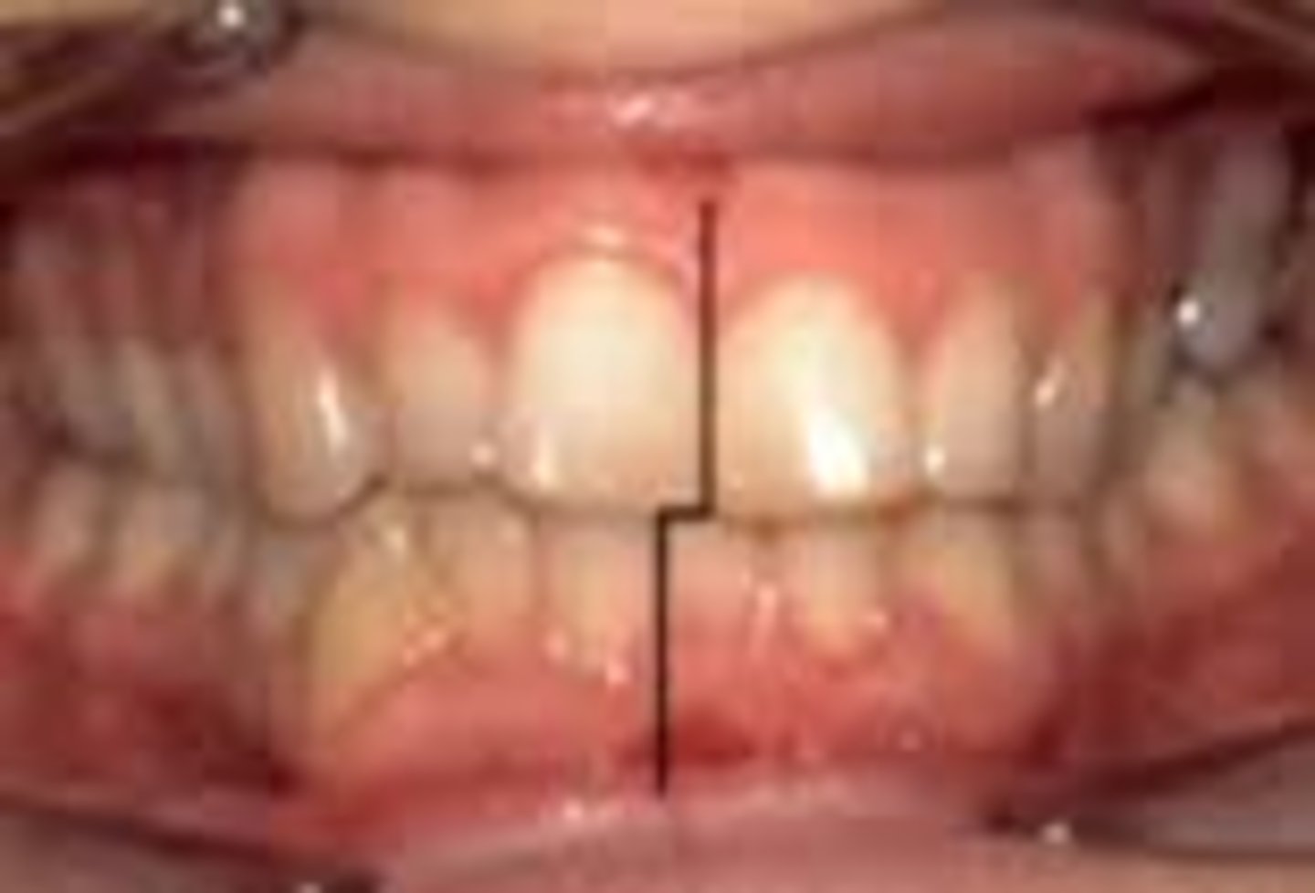 <p>Interproximals of maxillary centrals do not line up with interproximals of mandibular incisors</p>