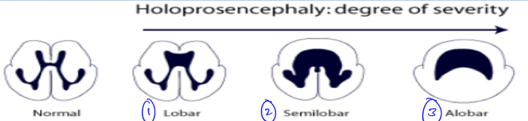 
1. lobar
2. semilobar
3. alobar