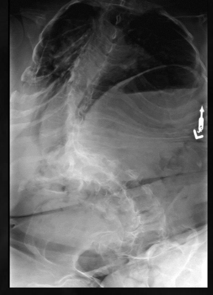 <p>what is seen here for this case of osteogenesis imperfecta?</p>