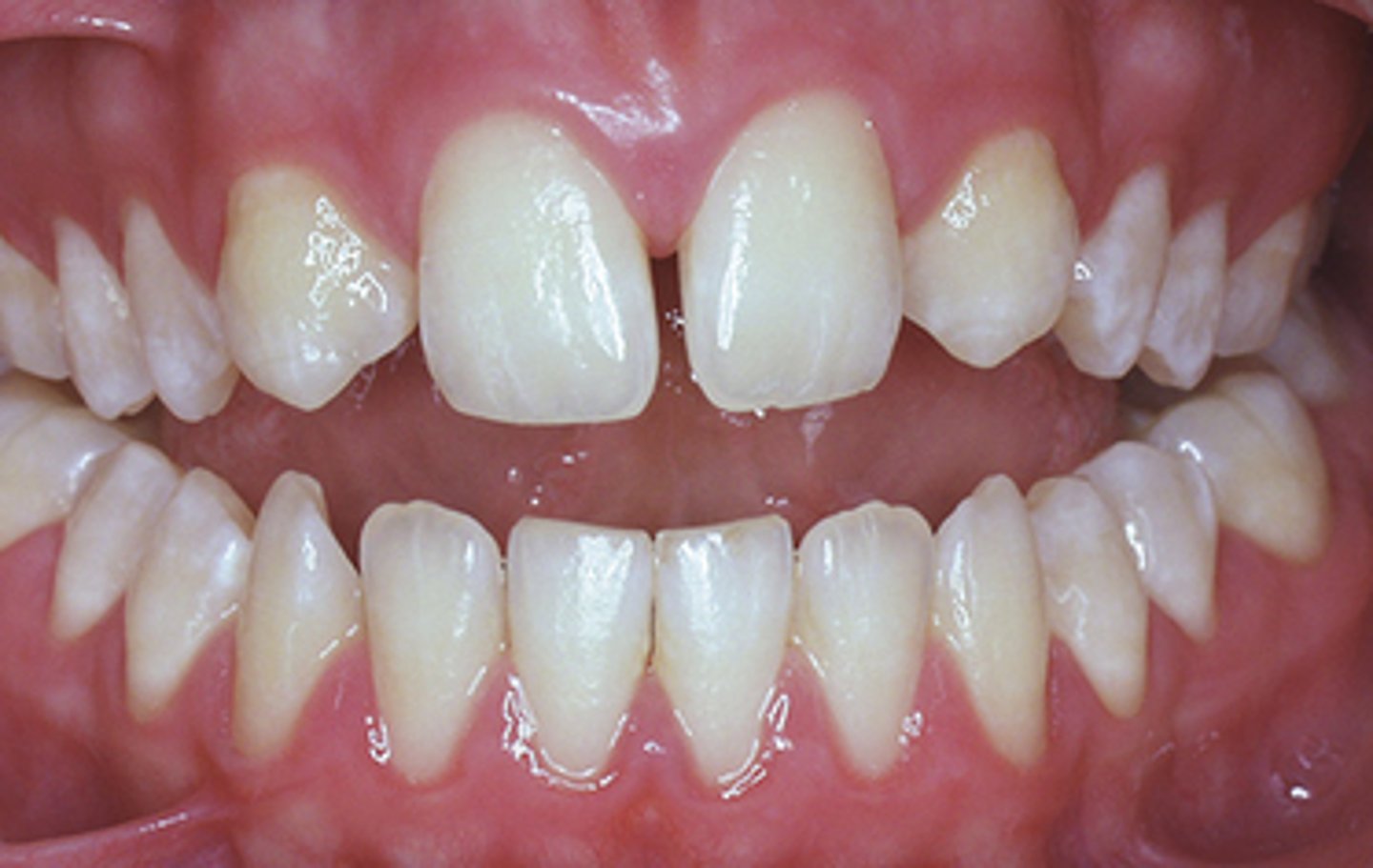 <p>Which two teeth are most likely to be congenitally missing?</p>