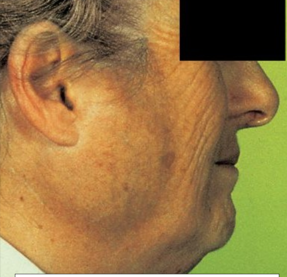 <p>What are "surgical mumps"?</p>