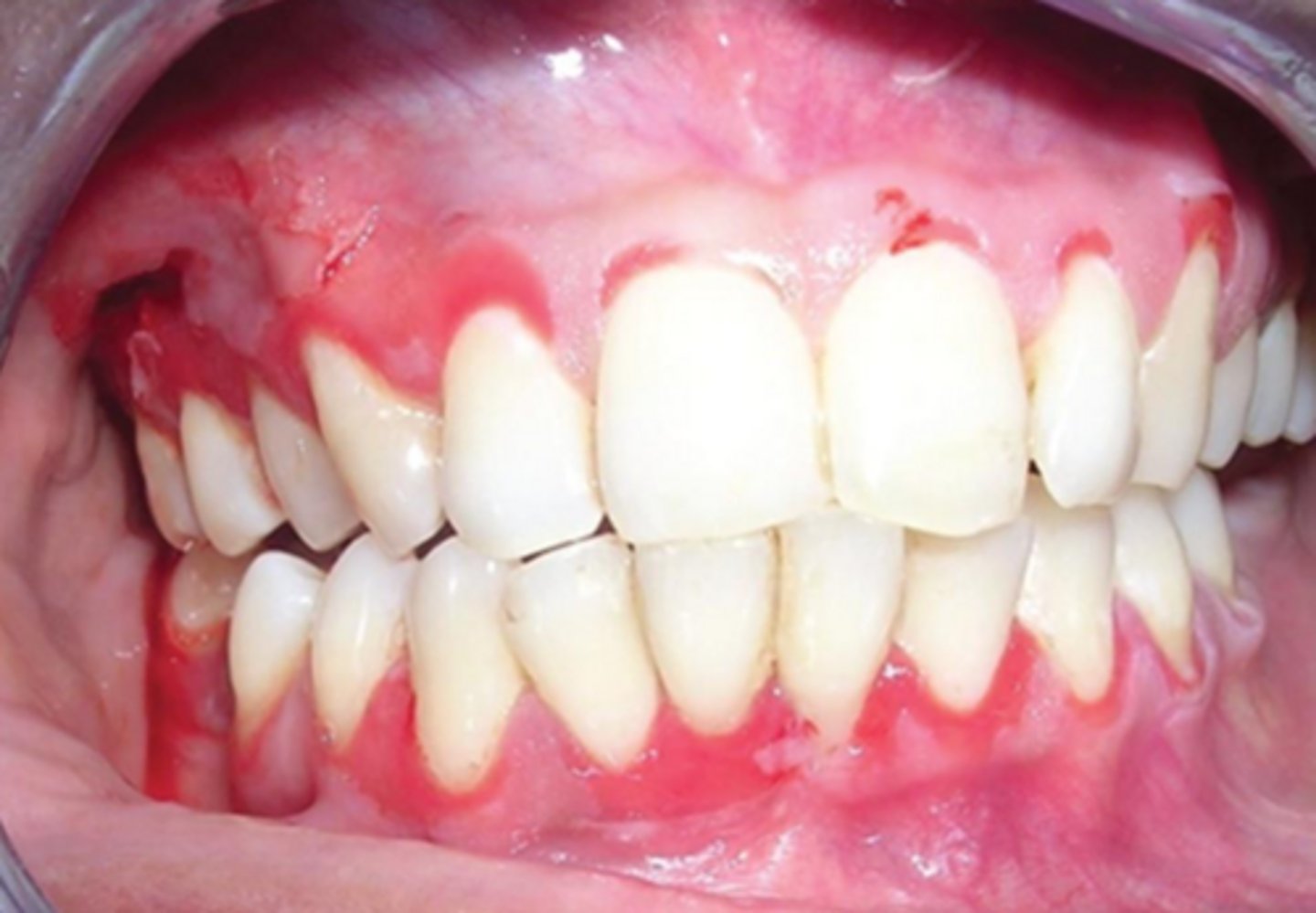 <p>topical corticosteroids</p>
