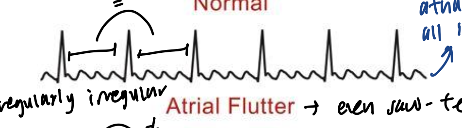 <ul><li><p>even saw-teeth</p></li><li><p>different clusters of atrial depolarized but independent of the SA node</p></li><li><p>“irregularly regular”</p></li></ul><p></p>