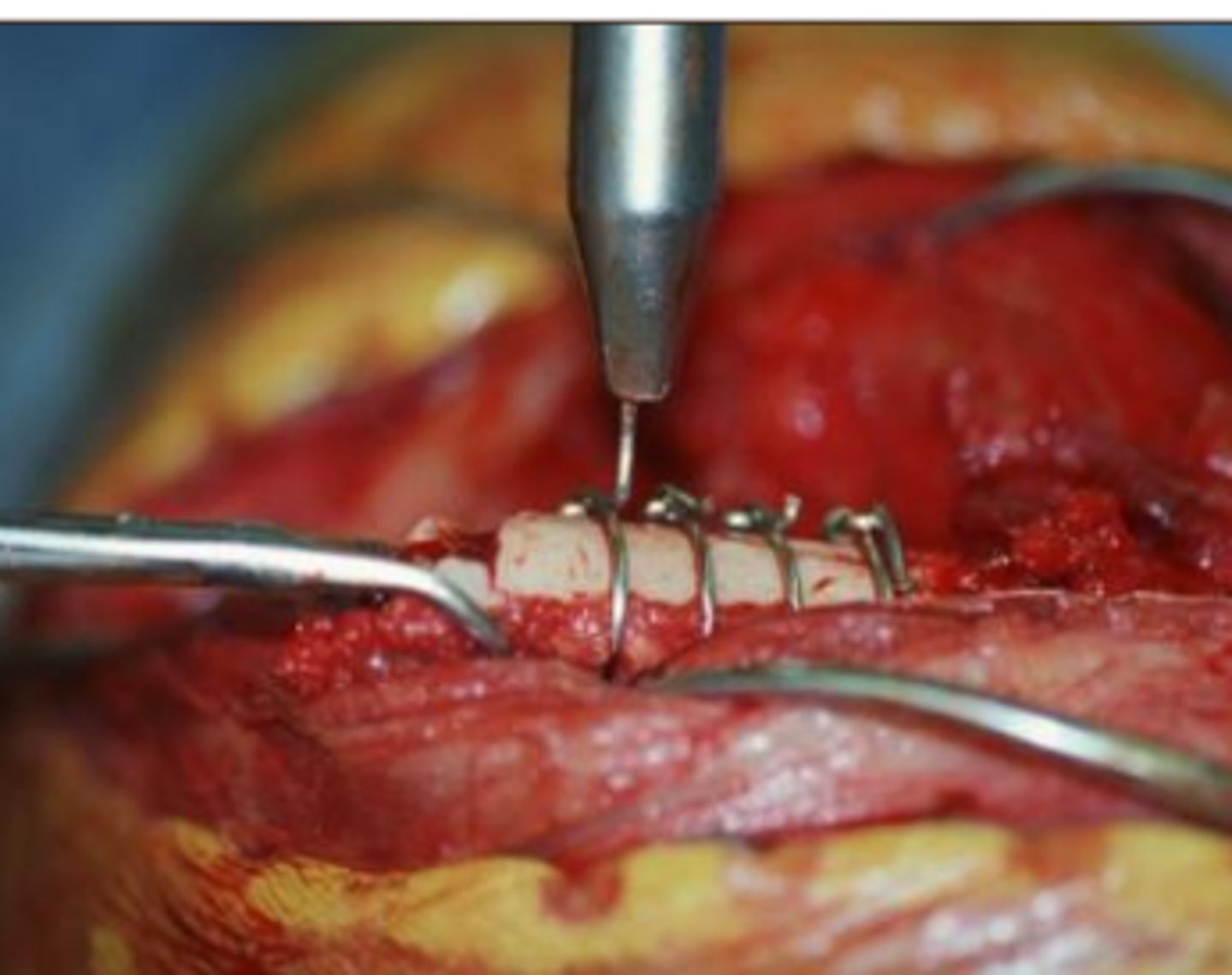 <p>Heavy gauge stainless steel wire placed circumferentially around the bone to provide fragment apposition and adjunctive fixation.</p>
