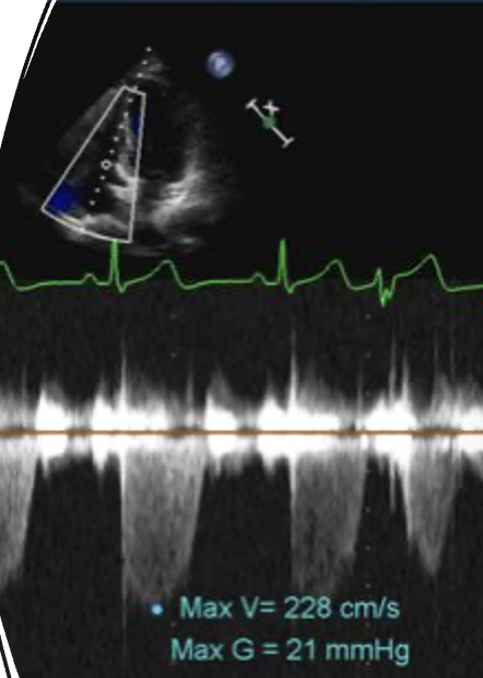 <p><span>__________is used to estimate right side pressures in the vessels leading to the lungs. This is used to determine pulmonary hypertension.</span></p>