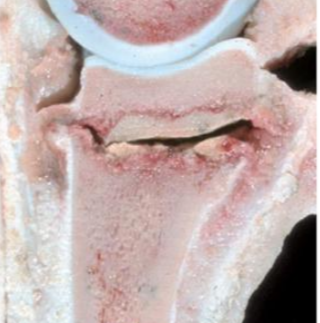 <p>→ Maladie inflammatoire infectieuse</p><ul><li><p>Porte d'entrée : Ombilic, appareil respiratoire, tube digestif</p></li><li><p>Site de prédilection : Réseau des vaisseaux artériels juste au-dessous/au-dessus de la zone du cartilage de croissance (cartilage articulaire et cartilage de conjugaison)</p><ul><li><p>Formation d’un micro abcès qui infiltre les parois (purulent)</p></li></ul></li></ul><p></p>