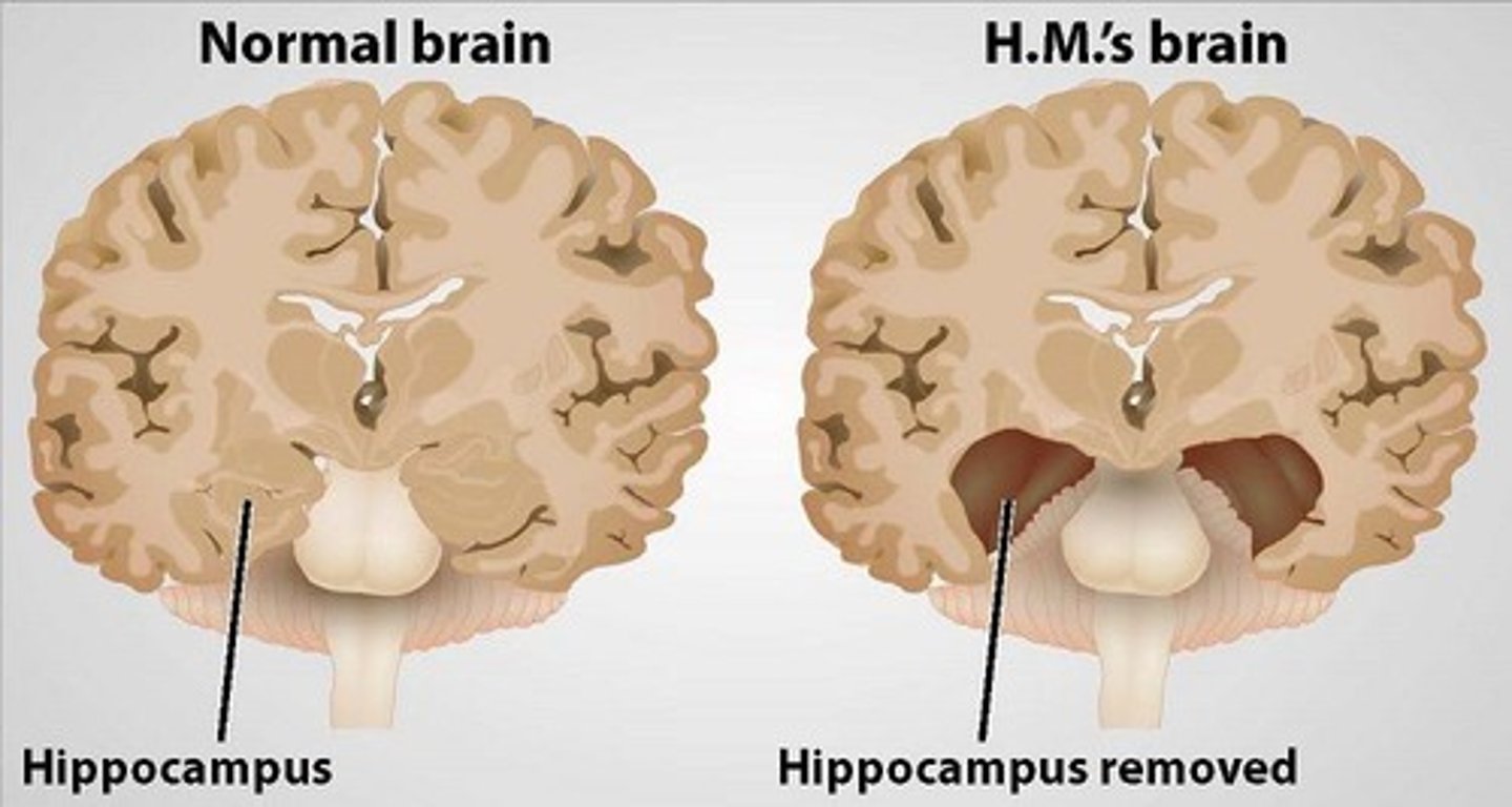 <p>bilateral medial temporal lobe removal</p>