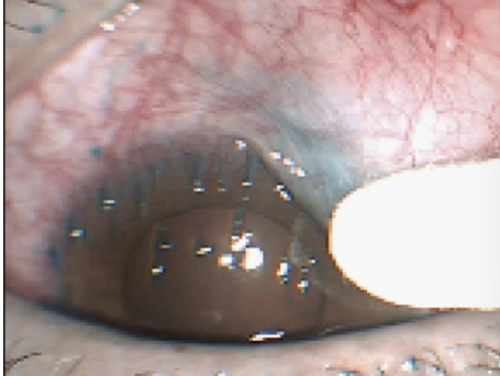 <p>Severe <u>foreign body sensation</u>, pain, photophobia, mucoid discharge, epiphora,</p>