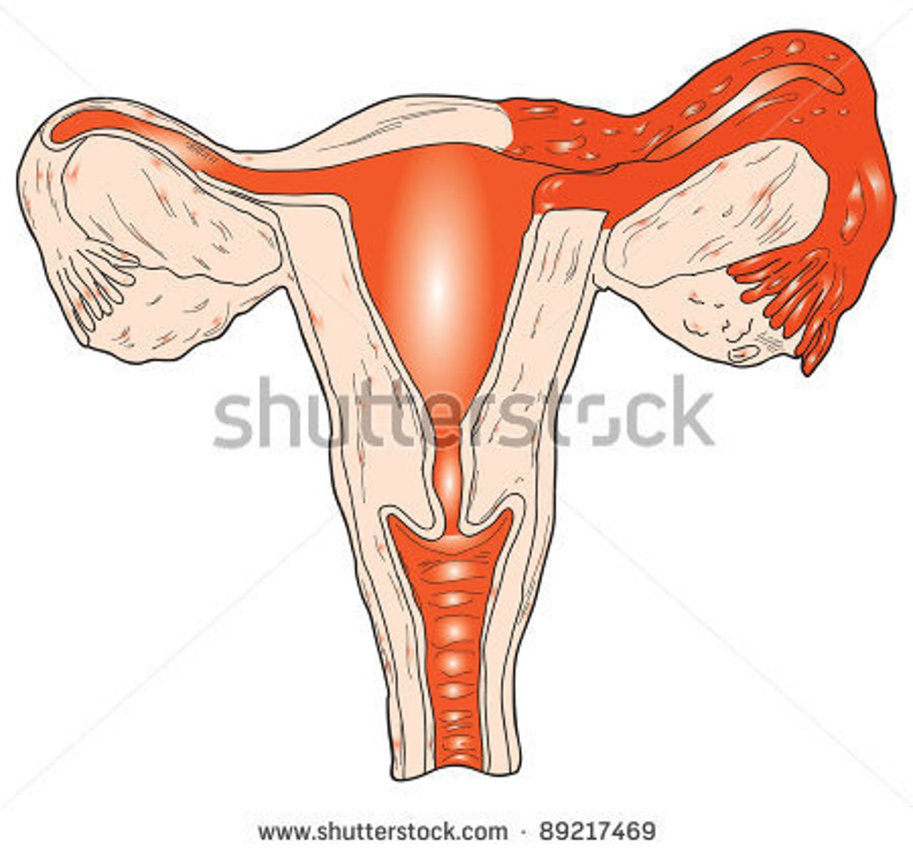 <p>inflammation of fallopian tube</p>