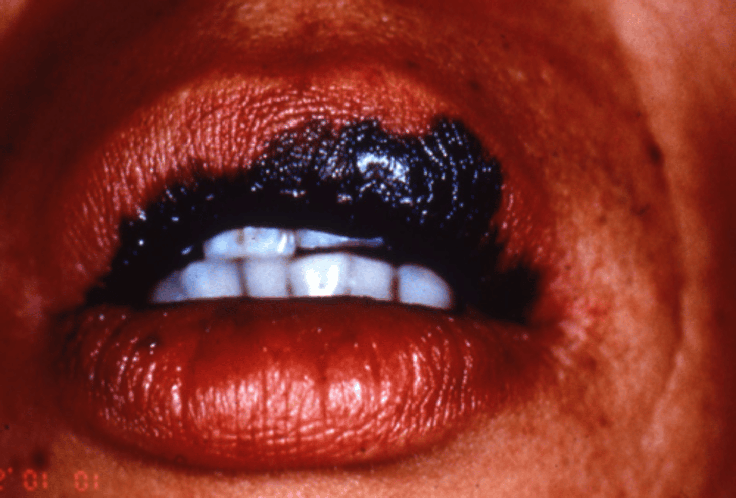 <p>palms, soles, oral mucosa</p><p>most common melanoma for POC</p>