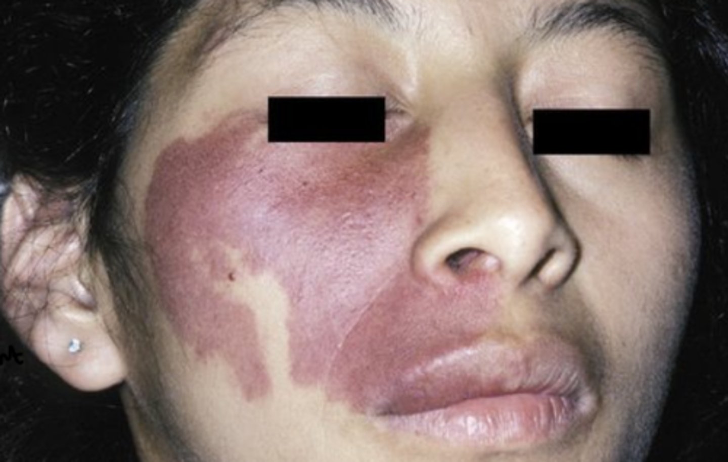 <p>Port wine stain of skin- follows distribution of TRIGEMINAL N.</p><p>10% of port wine stains are bilateral</p>