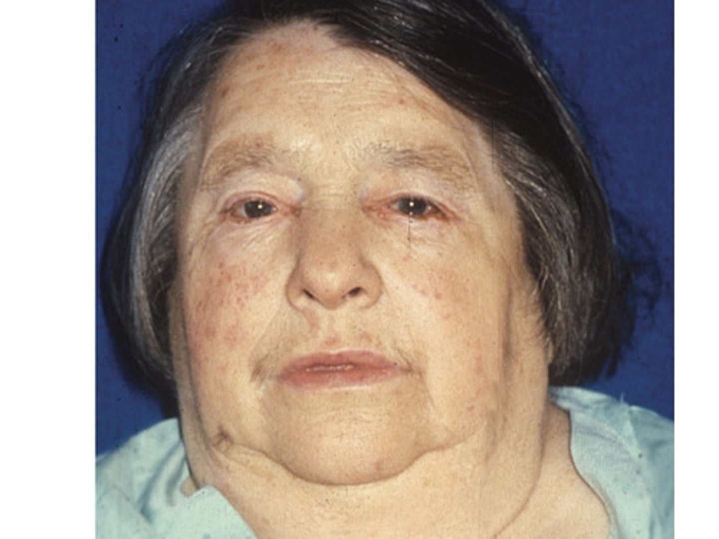 <p>Pale or yellow appearance "Peaches and cream" complexion Puffy face with periorbital oedema Dry,coarse hair</p><p>Diffuse hair loss</p><p>Loss of lateral eyebrow hair</p><p>(poor reliability)</p><p>Thickened dry flaking skin</p><p>Deep hoarse voice</p>