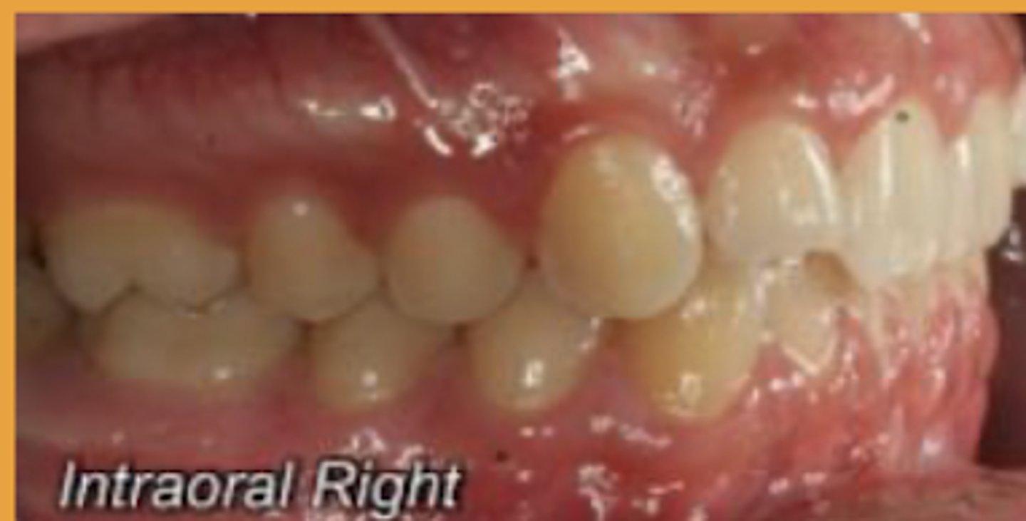 <p>Class I malocclusion</p>