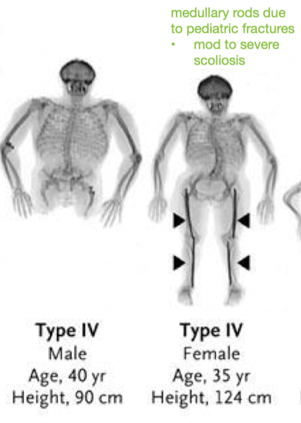 <p>How much bone fragility in <em><u>OI Type IV?</u></em> </p><ul><li><p>which deformity?</p></li></ul><p>Is there dentinogenesis imperfecta?</p><p>Hearing loss?</p><p>Prognosis for ambulation?</p>