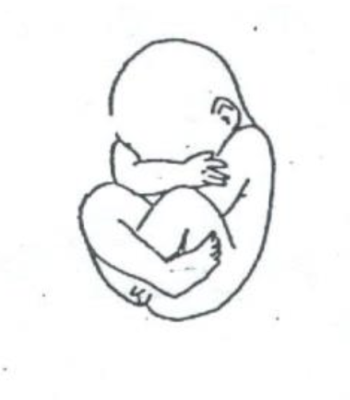 <p>vaginal delivery sometimes possible; <strong>fetus is flexed at both hips and knees, sitting “cross-legged</strong>”; risk of umbilical cord compression and birth injury</p>