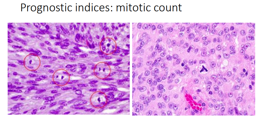 <p>count how many mitosis there are - and atypical forms which may indicate greater level of genetic derangement </p>