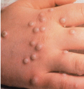 <p>Variola virus (Poxvirus family).</p><ul><li><p>Transmission? Respiratory droplets or contact with lesions.</p></li></ul><ul><li><p>Features of Smallpox rash include Deep, umbilicated pustules with thick yellow fluid; clustered on extremities.</p></li></ul><ul><li><p>Eradicated by vaccination (1980).</p></li></ul><p></p>