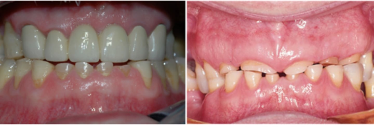 <p>What is a major concern when considering the treatment plan for these teeth?</p>