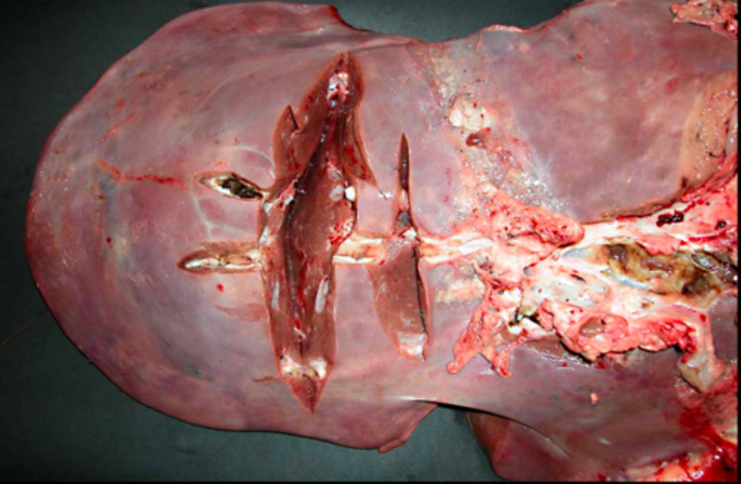 <p>Lever fra okse, hvad er den patoanatomiske diagnose?</p>