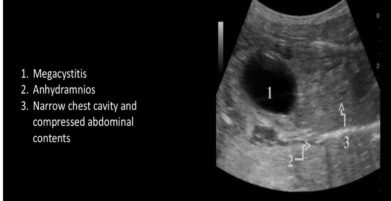 <p>a pt at 20w for suspected Eagle Barrett syndrome. which fetal structure should be closely evaluated </p><p>a) kidneys + bladder</p><p>b) amniotic bands</p><p>c) fetal brain</p><p>d) stomach + bowel</p>