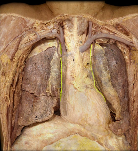 <p>Lateral to heart</p>