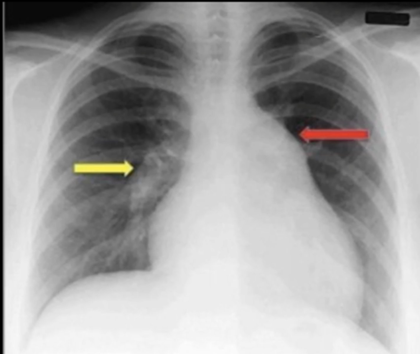 <p>(evaluating AP CXR) enlarged pulmonary vessel; enlarged aortic arch</p>