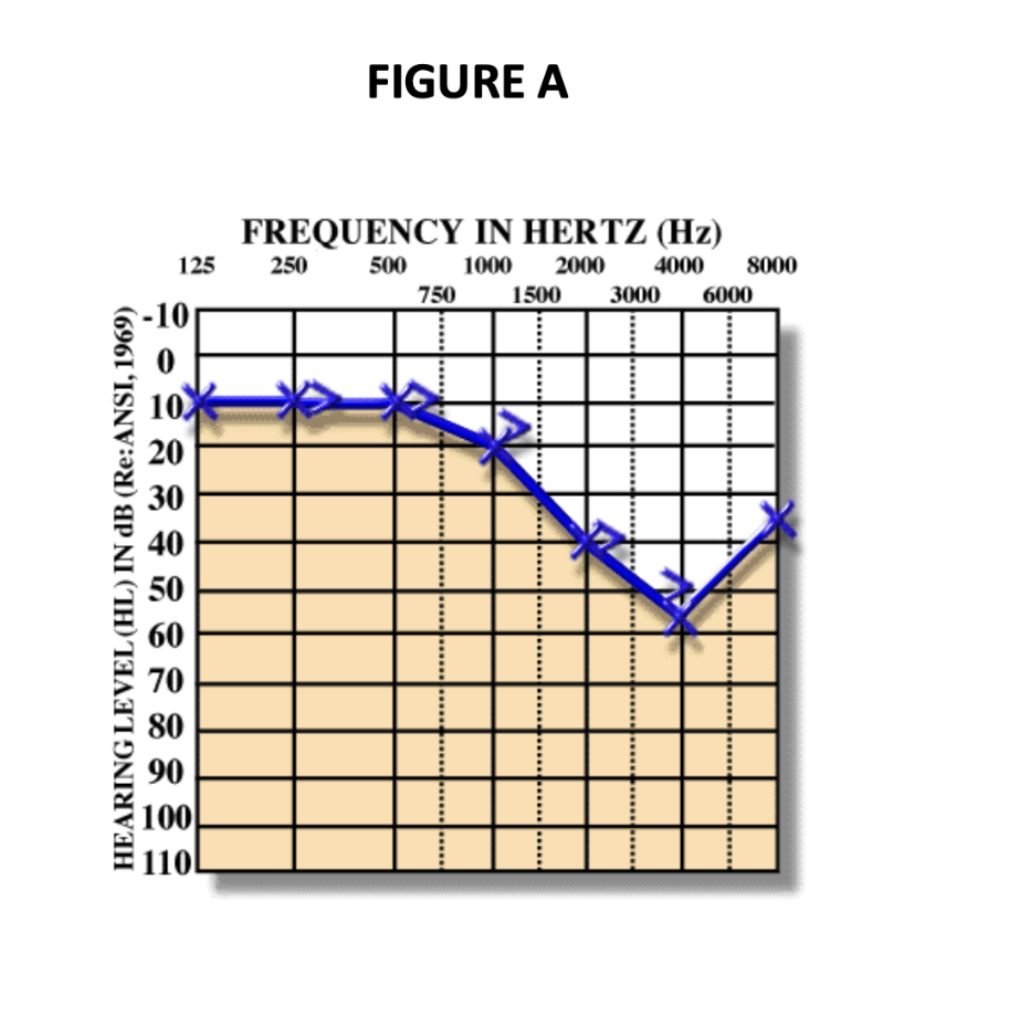 <p><strong>true or false? </strong>someone who has a hearing configuration like the one shown in figure A below is very likely to have sensorineural hearing loss that is due to noise exposure</p>