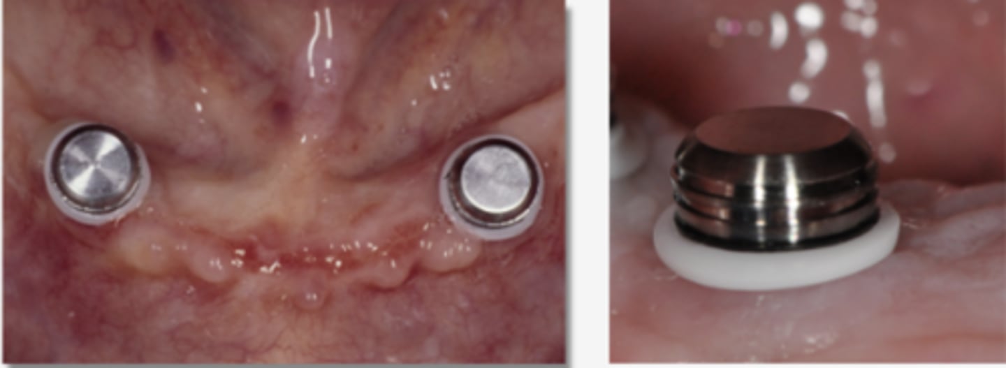 <p>What is the purpose of the white block-out spacer or rubber dam during the pick-up procedure for the locator processing cap assembly? (Select one)</p><p>A. Enhance the aesthetics of the final denture.</p><p>B. Verify that the denture sits securely without rocking.</p><p>C. Ensure there are no occlusal interferences or premature contacts for the patient.</p><p>D. Create space for the acrylic resin during the pick-up procedure.</p><p>E. Prevent excess pick-up material from locking the denture in place.</p>
